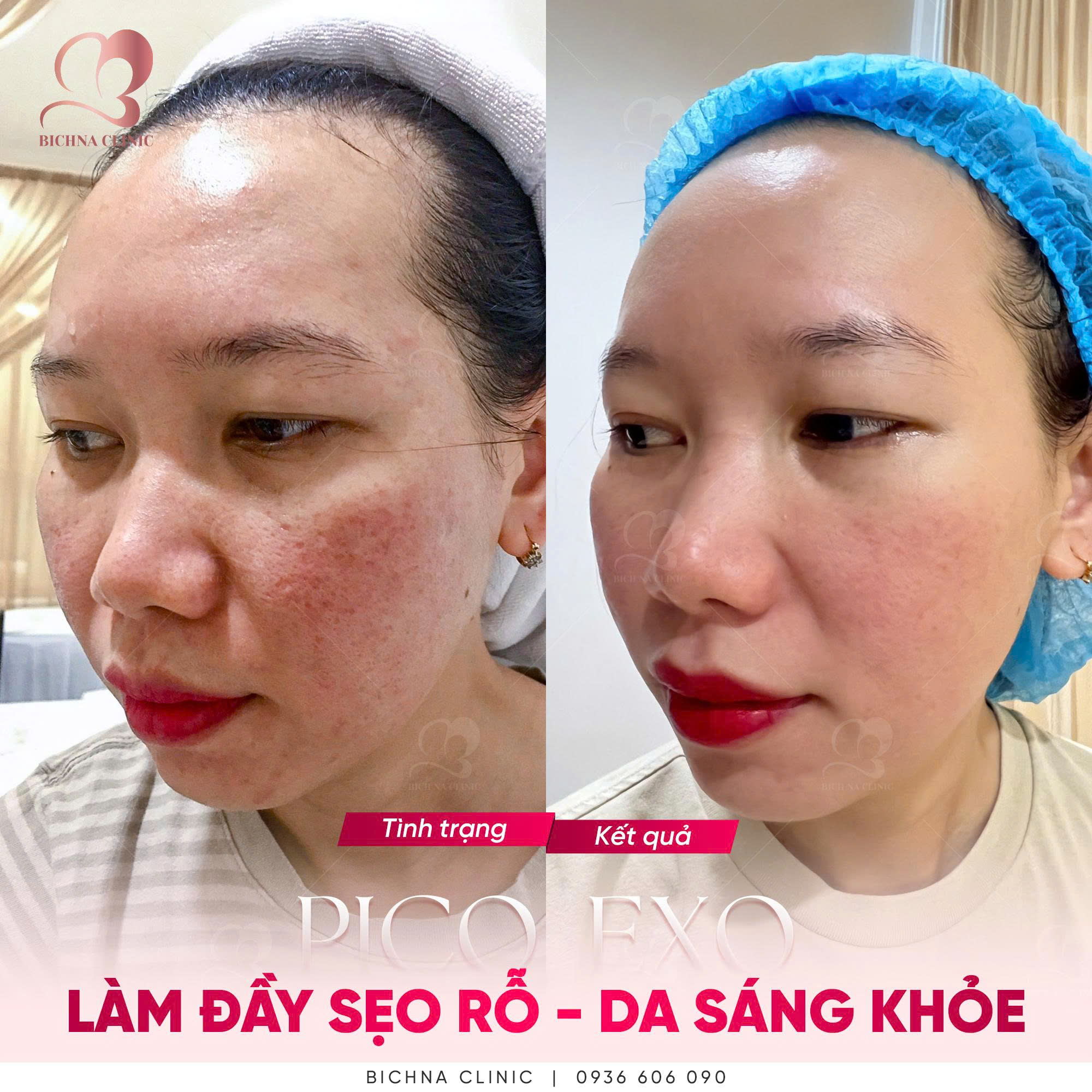 Hình ảnh thực tế khách hàng điều trị sẹo rỗ và làm sáng da bằng công nghệ Pico Exo tại BichNa Clinic