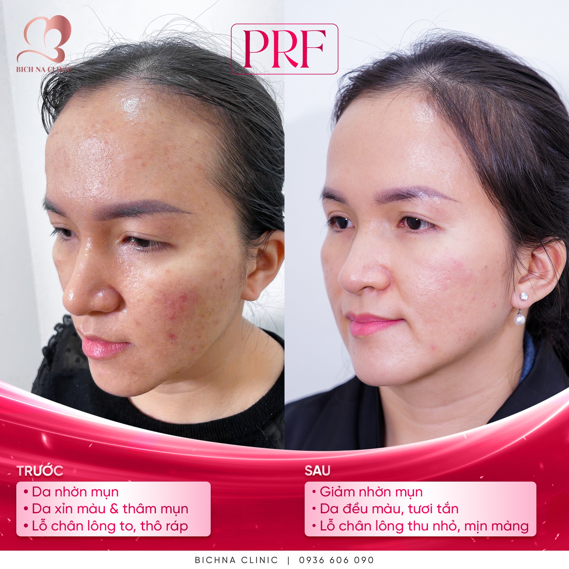 Điều trị mụn tái phát và sẹo lõm hiệu quả bằng PRF tại BichNa Clinic.