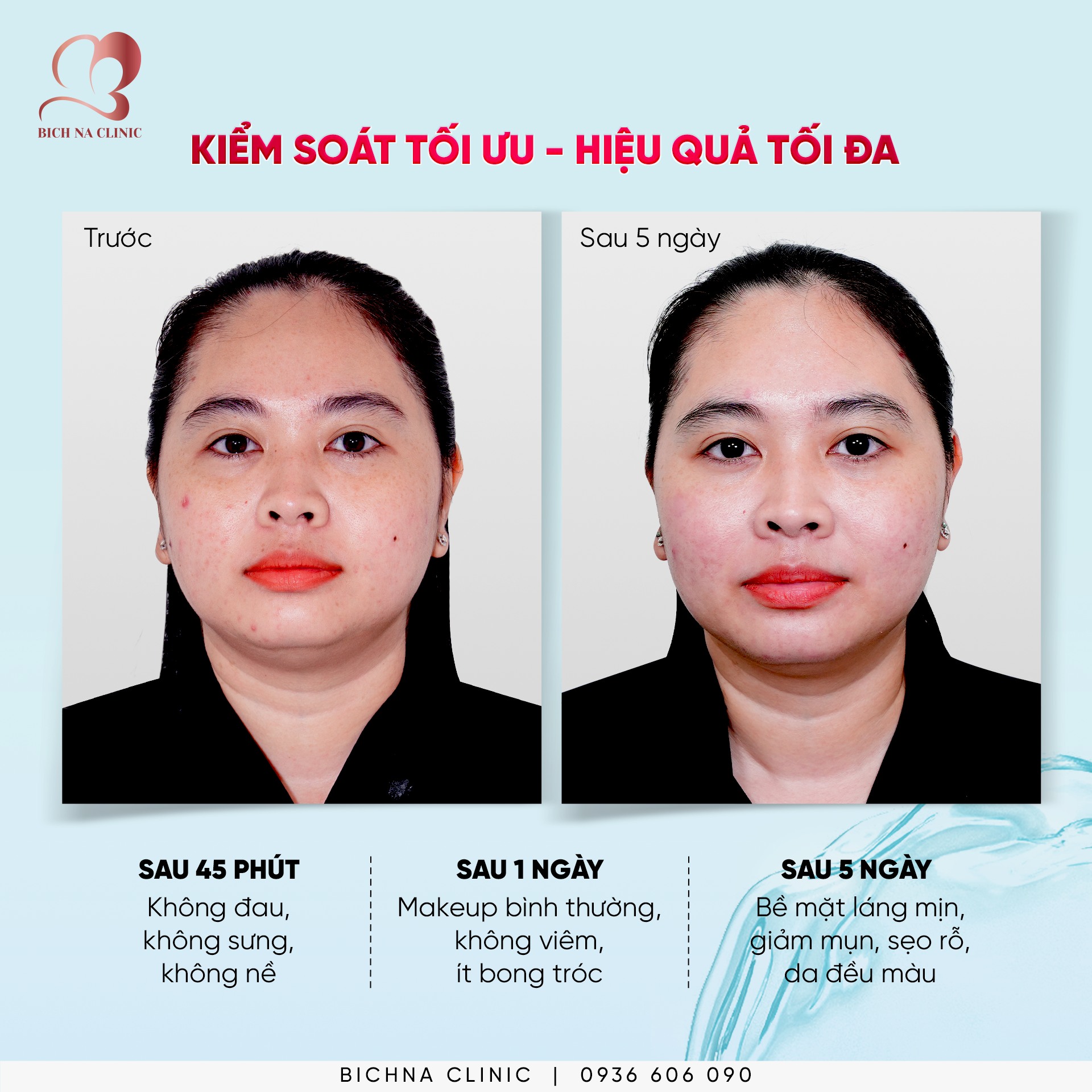 Kết quả khách hàng điều trị mụn sẹo bằng liệu trình Regen Exo tại BichNa Clinic