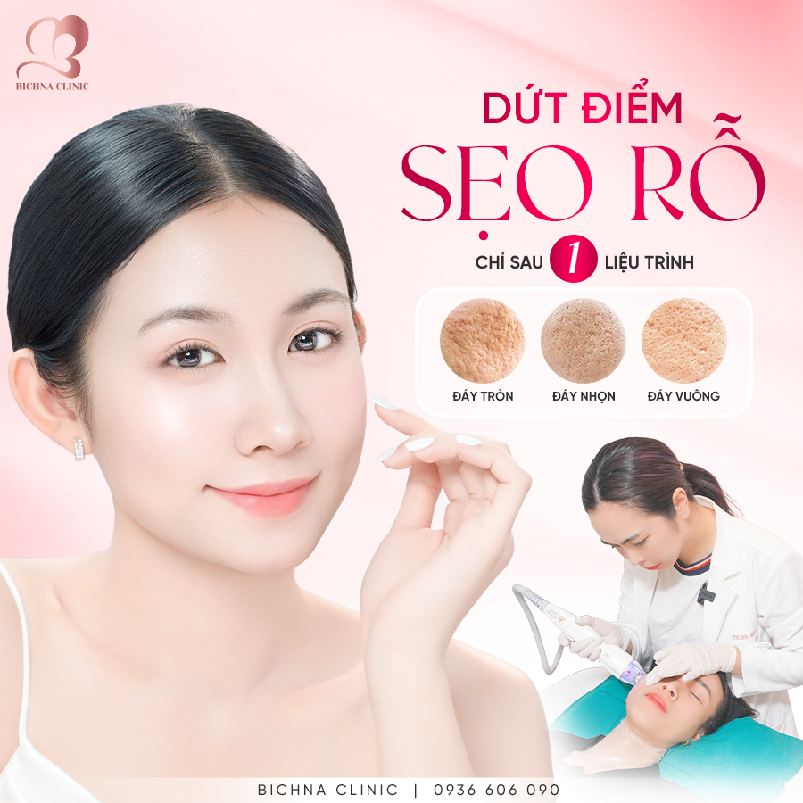 Điều trị dứt điểm các loại sẹo rỗ đáy tròn, đáy nhọn, đáy vuông tại BichNa Clinic