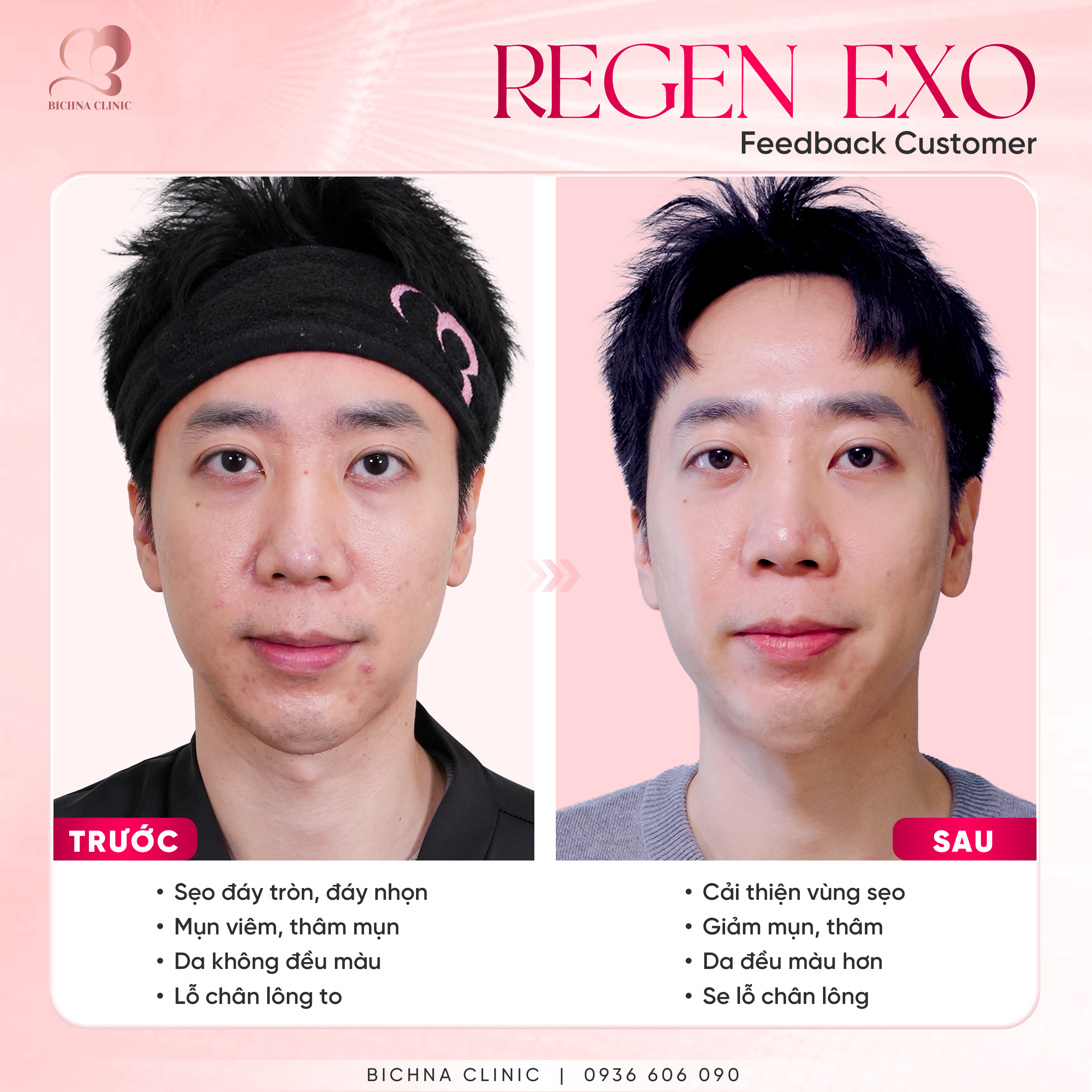Hình ảnh trước và sau điều trị Regen Exo tại BichNa Clinic cho thấy sự cải thiện sẹo rỗ, giảm mụn, mờ thâm và giúp da đều màu hơn.