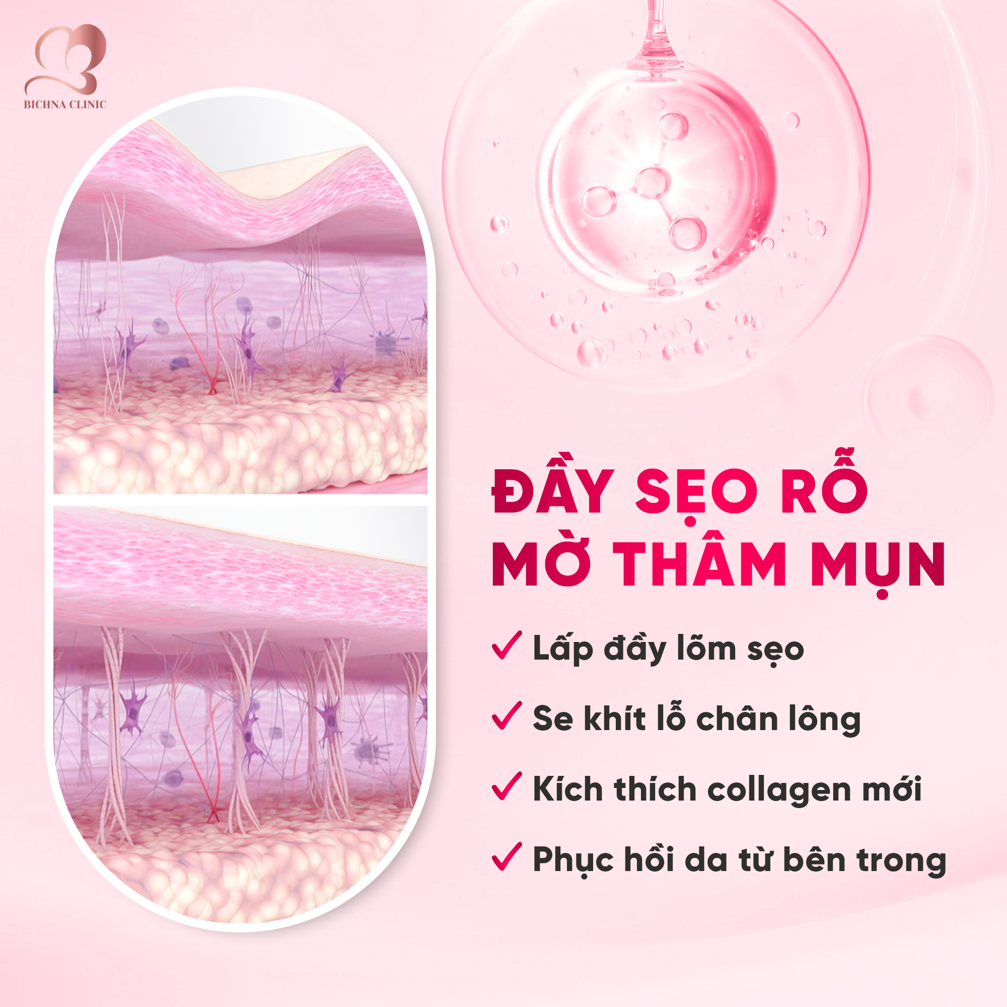 Minh họa cơ chế hỗ trợ cải thiện sẹo rỗ, làm mờ thâm mụn và kích thích tăng sinh collagen trong điều trị da.