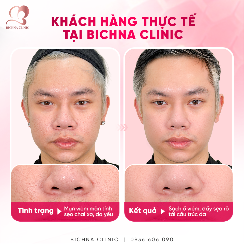 Kết quả điều trị sẹo rỗ tại BichNa Clinic giúp cải thiện sẹo chai xơ, giảm mụn viêm và nâng cao chất lượng nền da.