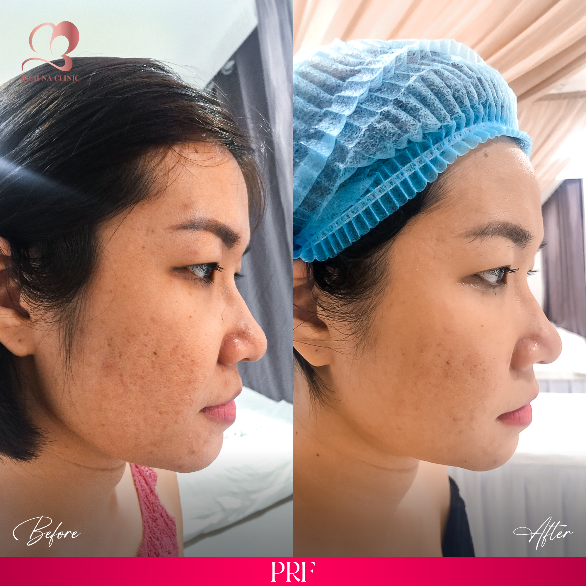 Hình ảnh Before - After điều trị PRF tại BichNa Clinic, hỗ trợ cải thiện thâm mụn, sẹo mụn, lỗ chân lông to và phục hồi nền da.
